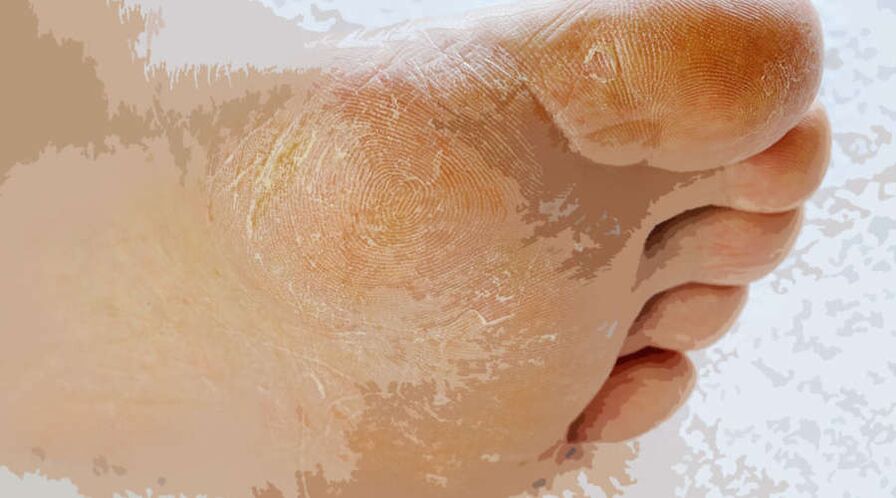 Mycosis của bàn chân