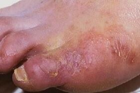 biểu hiện của nhiễm trùng nấm trên da chân