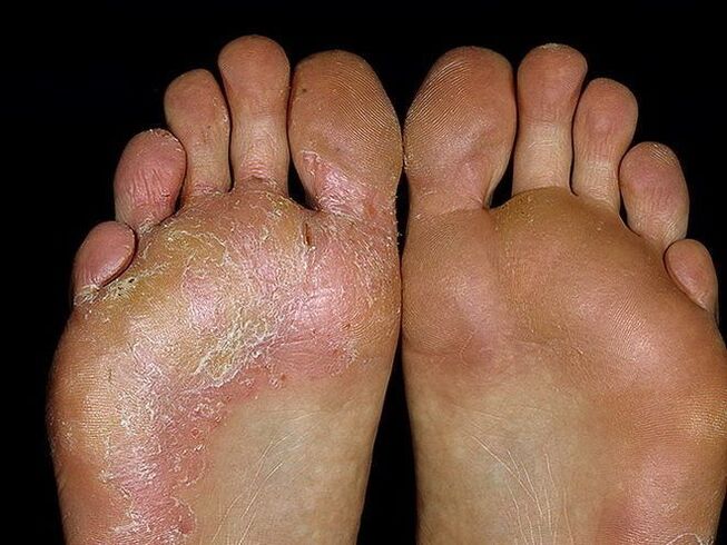 các triệu chứng của nấm ở chân