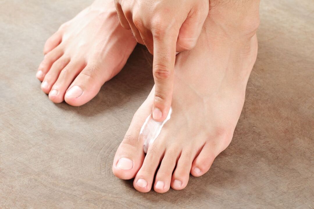 điều trị nấm trên bàn chân bằng thuốc mỡ