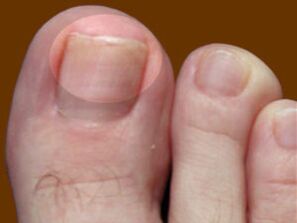 Nấm móng chân - một dấu hiệu cho việc sử dụng thuốc nhỏ thuốc diệt nấm