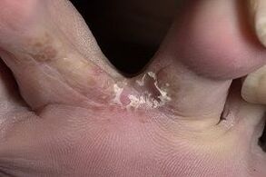 nấm da giữa các ngón chân