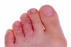 triệu chứng nấm ngón chân