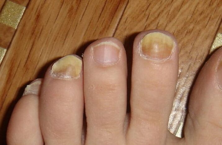 các triệu chứng của nấm trên móng tay và da chân