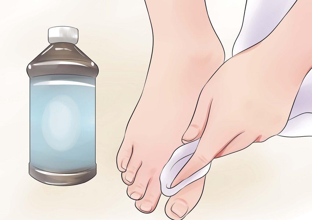 hydrogen peroxide đối với nấm móng chân